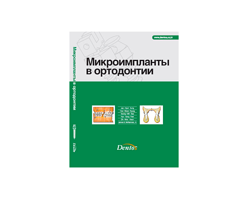 Микроимпланты в ортодонтии